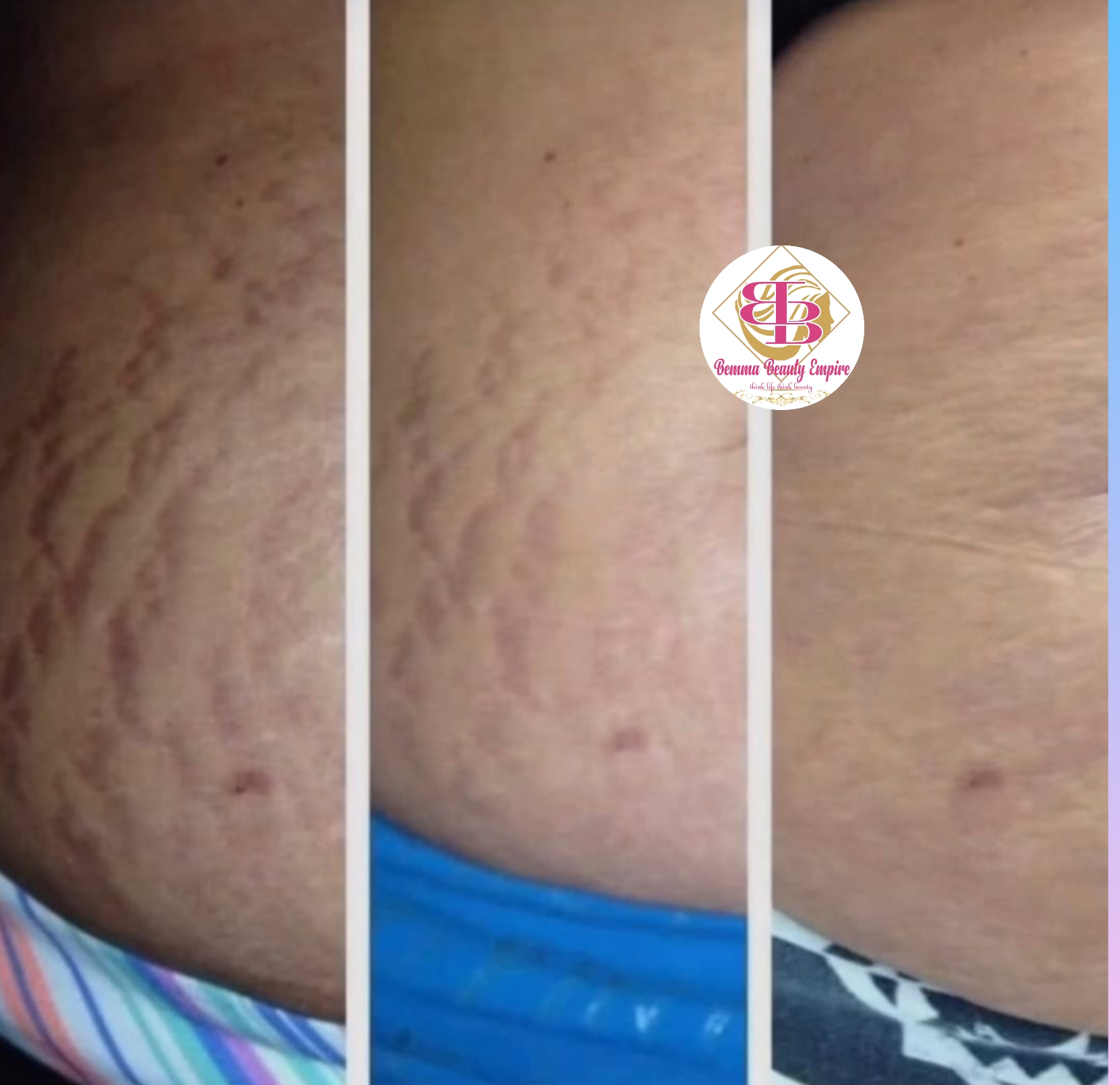 Stretch marks 3n1 set. Oil+soap +scrub - Image 9