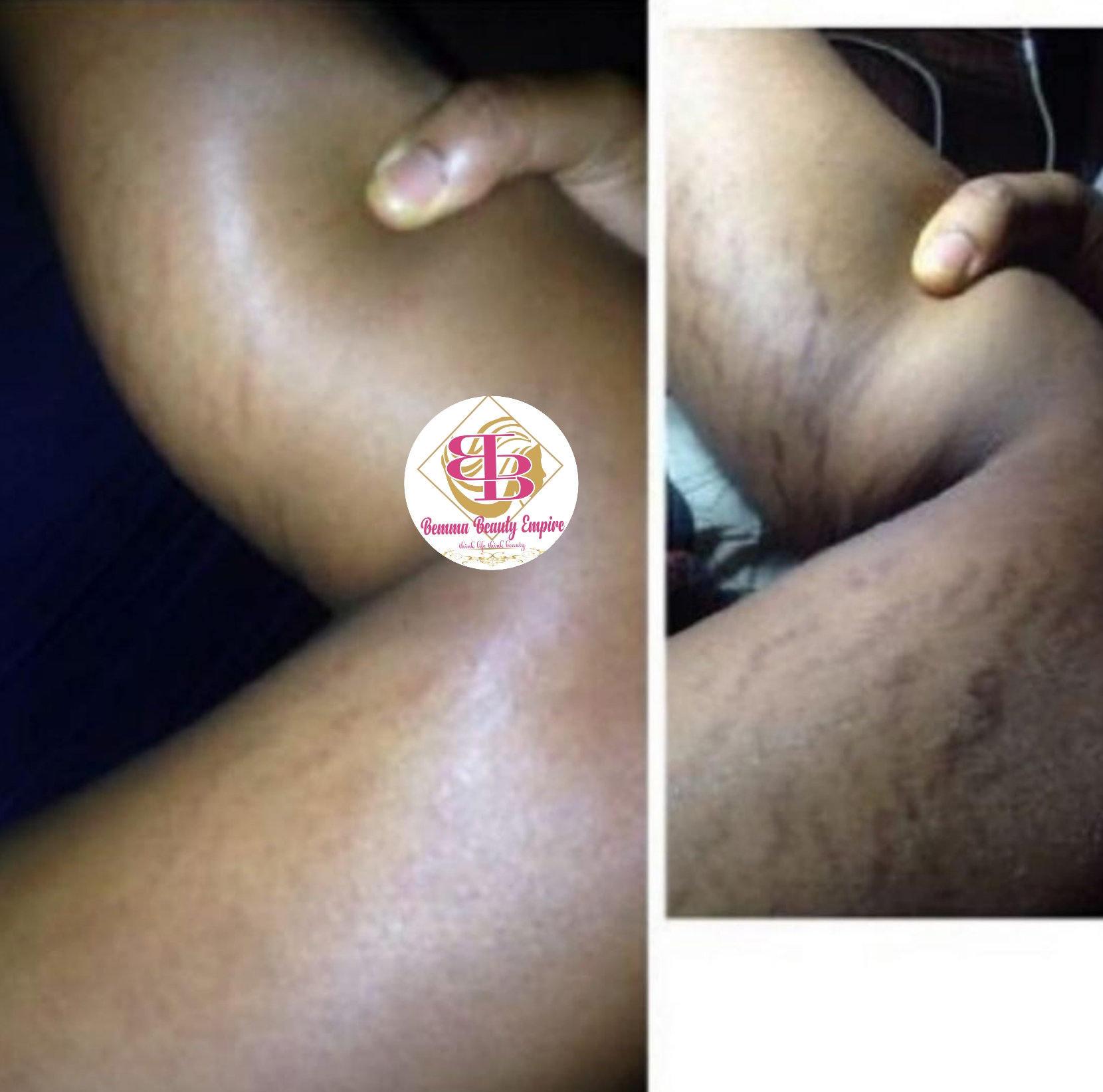 Stretch marks 3n1 set. Oil+soap +scrub - Image 11
